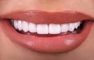 Dental veneers